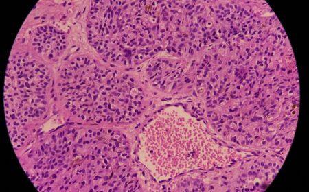 Non-melanoma skin cancer killing more people than melanoma, new study finds